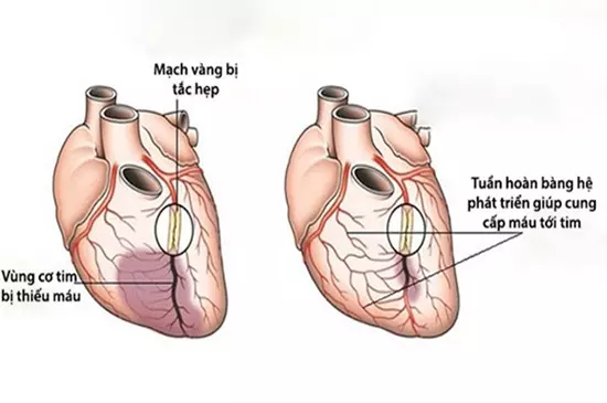 Tuần hoàn bàng hệ phát triển giúp bù trừ cho tình trạng thiếu máu cơ tim.webp